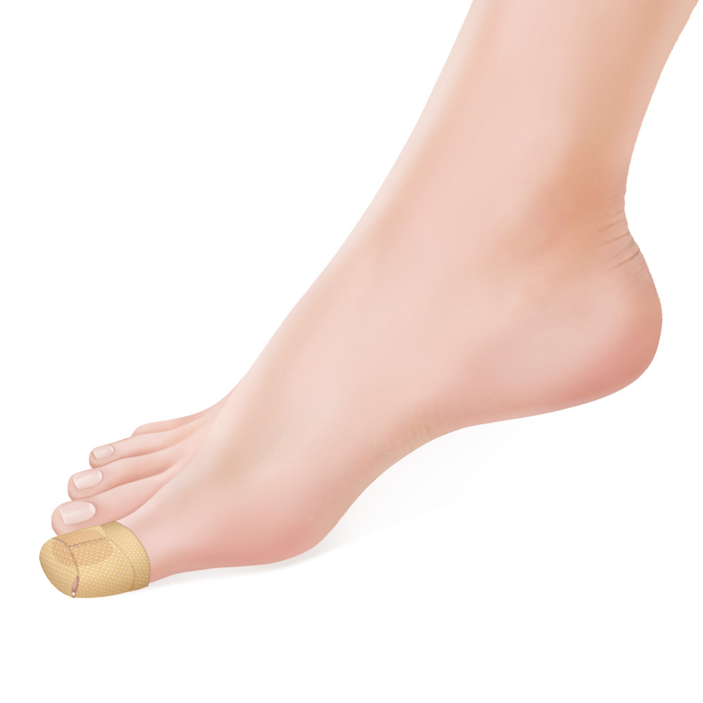 Antifungal plasters for fingernails and toenails with 40% of Urea 12 pcs