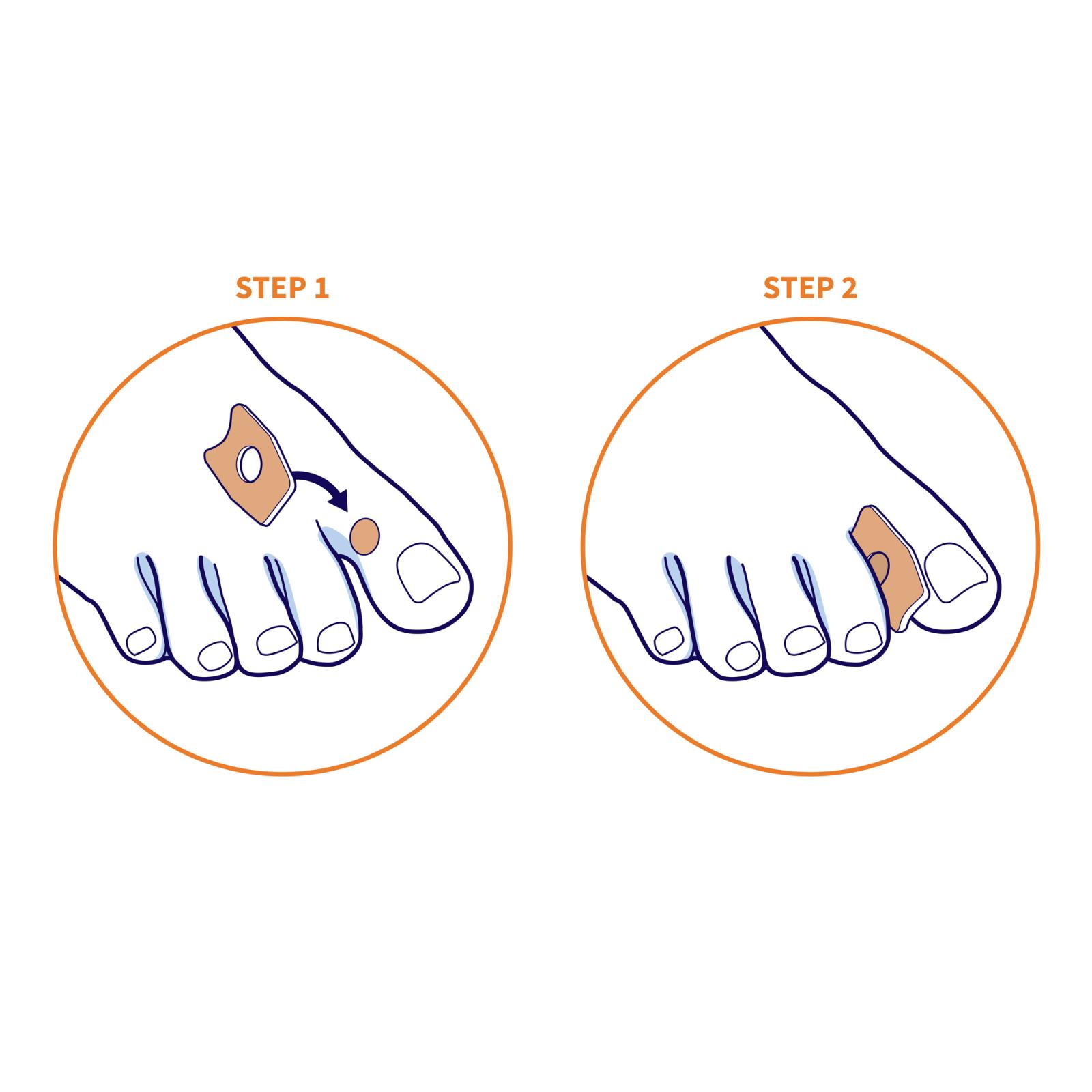 Toe plasters with 40% of Salicylic Acid 6 pcs