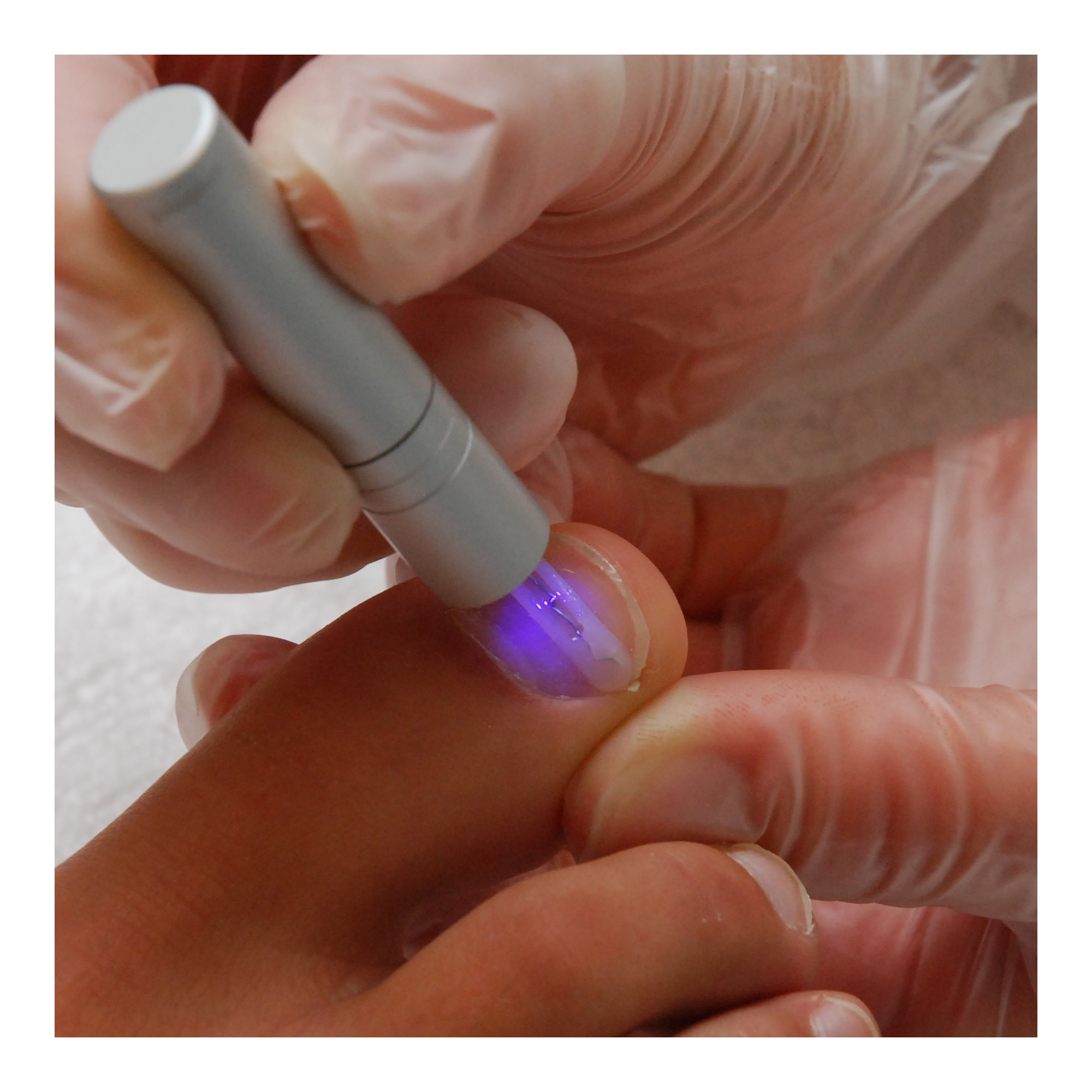 UV micro-lamp for PediGel Podofix