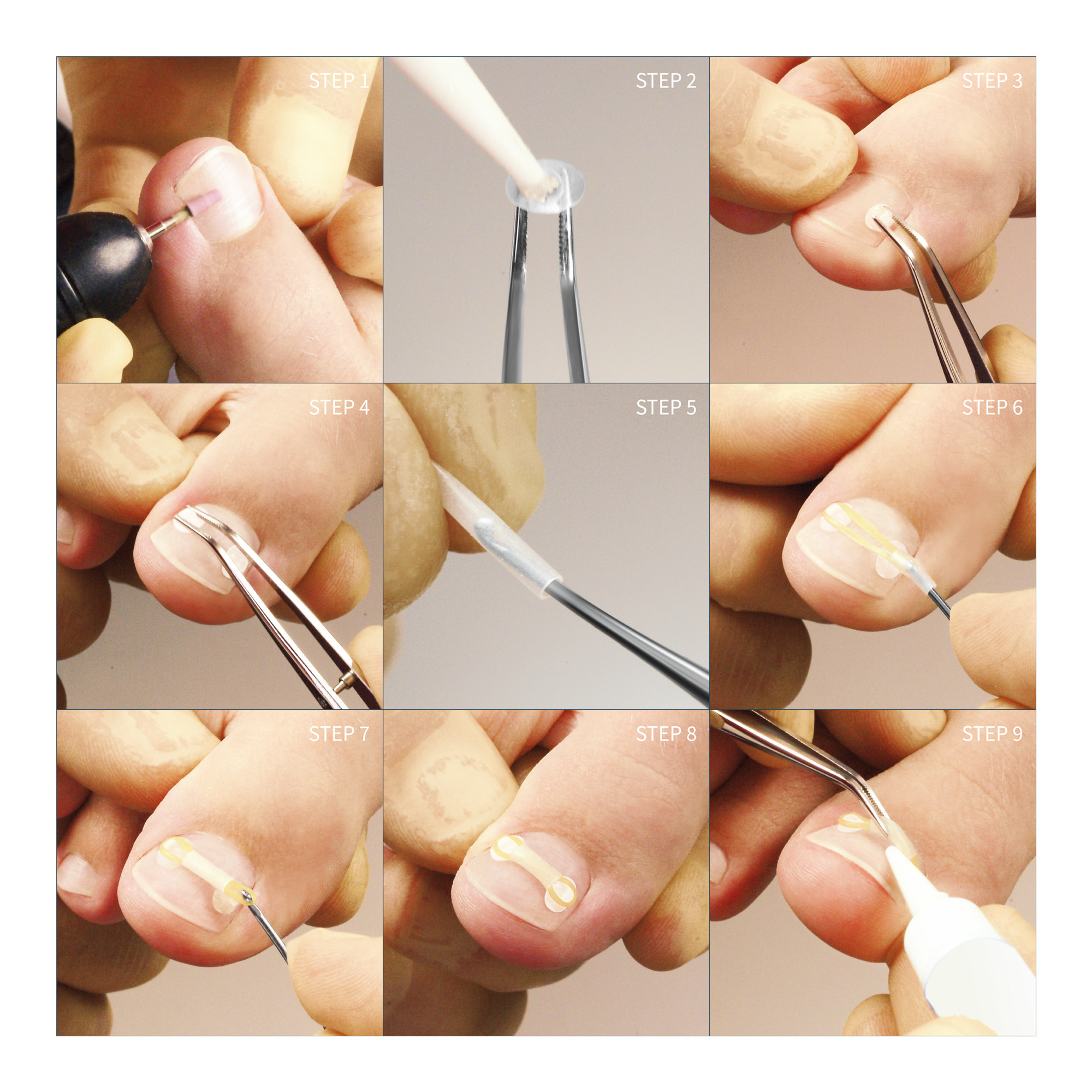 Hook instrument for Erki nail correction system