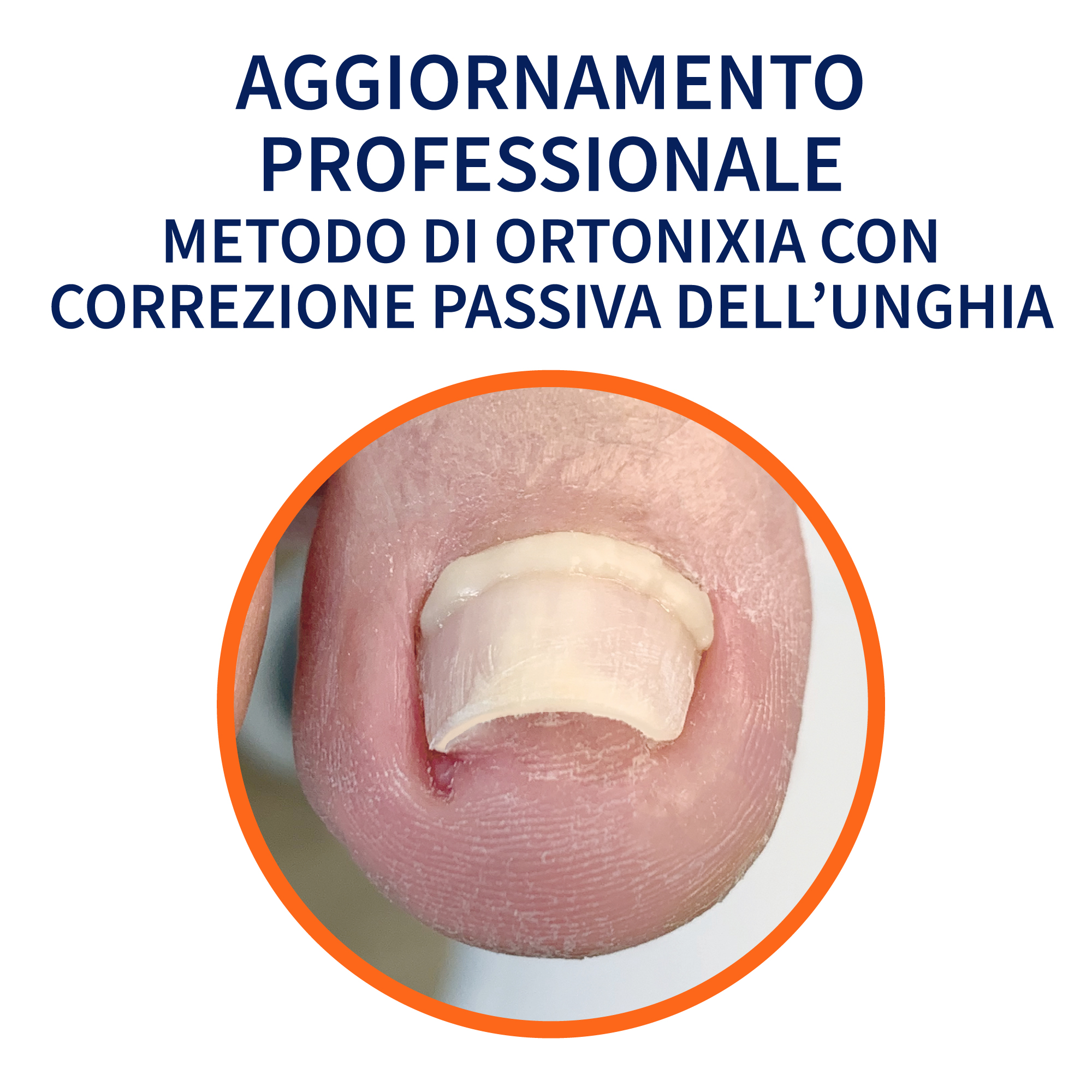 Aggiornamento Professionale Metodo di Ortonixia con correzione passiva dell'unghia