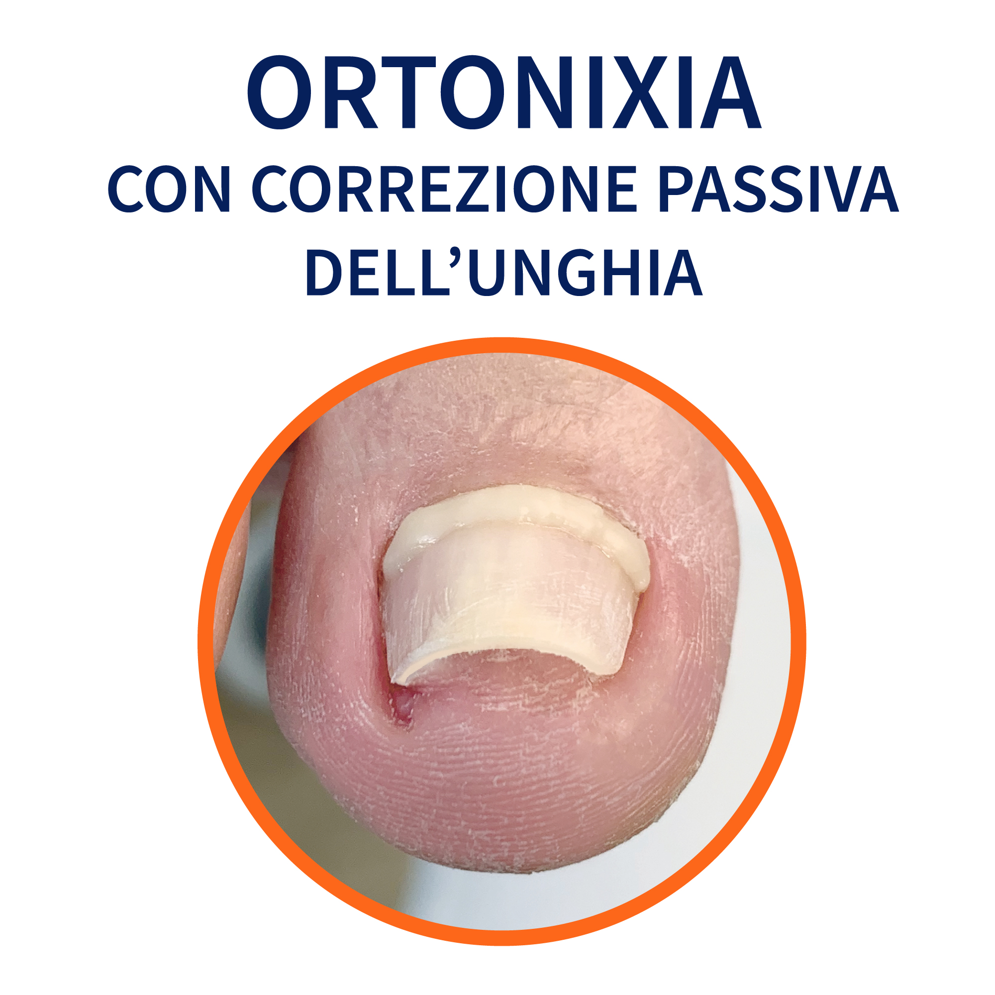 Aggiornamento Professionale Metodo di Ortonixia con correzione passiva dell'unghia